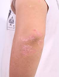 pikkelysömör kezelése viasz és méz alapján a lábakon vörös foltok viszketnek az